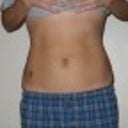 2 months after smart lipo - front